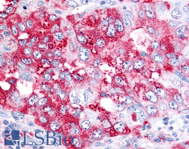 BEST4 Antibody - Anti-BEST4 antibody IHC of human Lung, Non-Small Cell Carcinoma. Immunohistochemistry of formalin-fixed, paraffin-embedded tissue after heat-induced antigen retrieval.