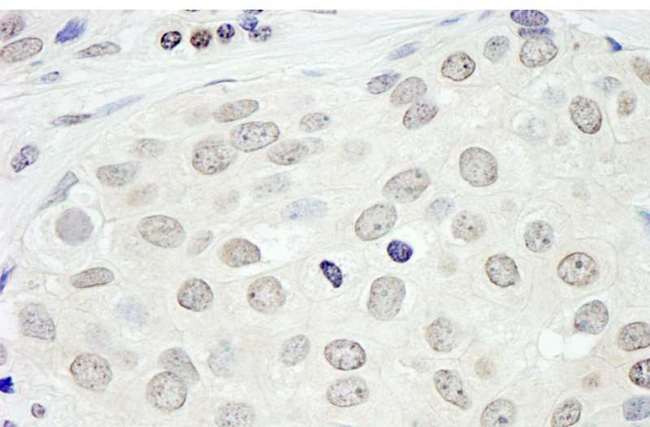 BRD2 / RING3 Antibody - Detection of Human BRD2 by Immunohistochemistry. Sample: FFPE section of human breast carcinoma. Antibody: Affinity purified rabbit anti-BRD2 used at a dilution of 1:200 (1 ug/ml).