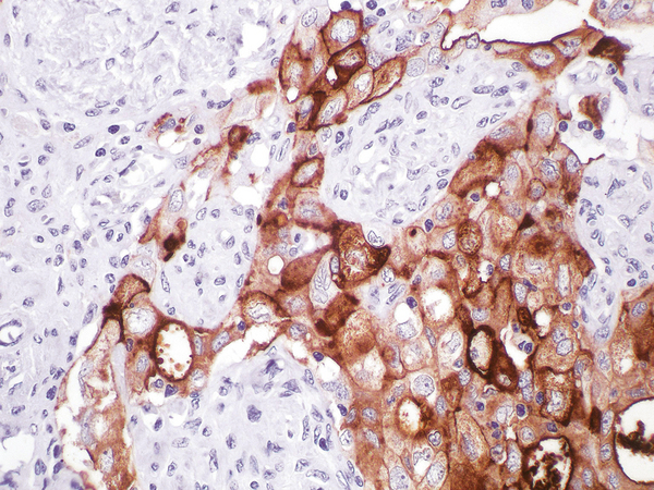 CA125 Antibody - CA-125 on Ovary