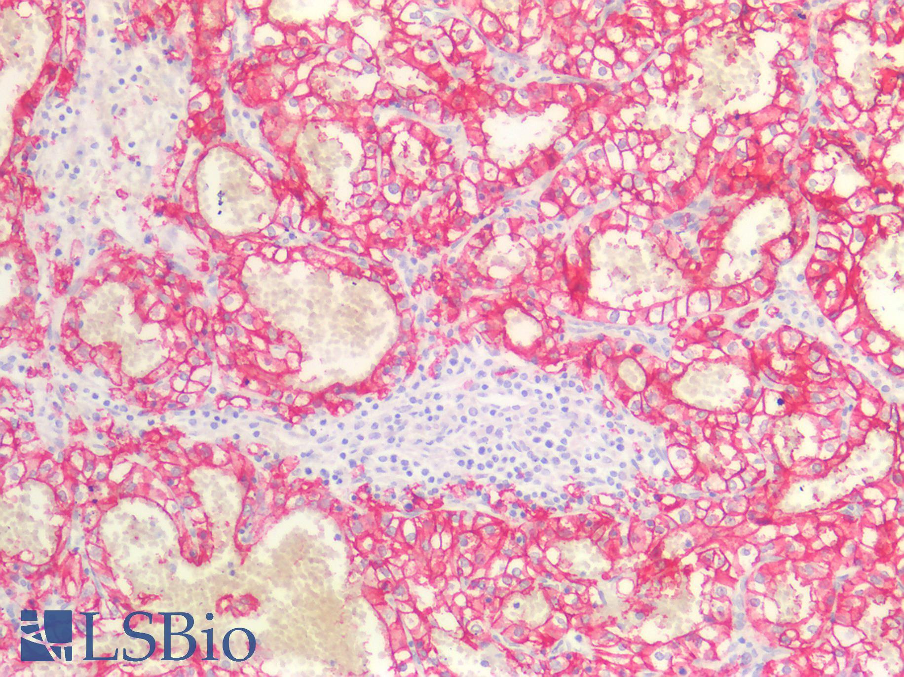 CA9 / Carbonic Anhydrase IX Antibody - Human Kidney Renal Cell Carcinoma: Formalin-Fixed, Paraffin-Embedded (FFPE)