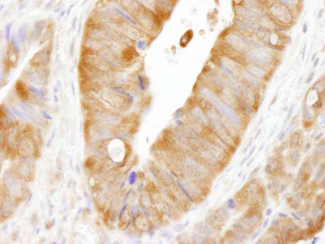 CAD Antibody - Detection of Human CAD by Immunohistochemistry. Sample: FFPE section of human colon carcinoma. Antibody: Affinity purified rabbit anti-CAD used at a dilution of 1:200 (1 ug/ml).