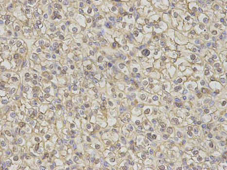 Calgizzarin / S100A11 Antibody - Immunohistochemistry of paraffin-embedded human kidney cancer using S100A11 antibody at dilution of 1:200 (400x lens).