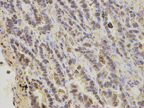 Calgizzarin / S100A11 Antibody - Immunohistochemistry of paraffin-embedded human lung cancer using S100A11 antibody at dilution of 1:200 (400x lens).
