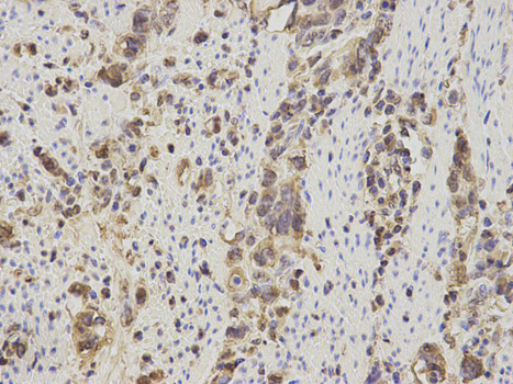Calgizzarin / S100A11 Antibody - Immunohistochemistry of paraffin-embedded human stomach cancer using S100A11 antibody at dilution of 1:200 (400x lens).