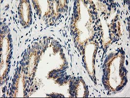 CAT / Catalase Antibody - IHC of paraffin-embedded Carcinoma of Human prostate tissue using anti-CAT mouse monoclonal antibody.