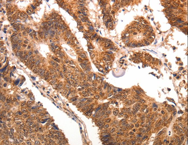 CCL17 / TARC Antibody - Immunohistochemistry of paraffin-embedded Human colon cancer using CCL17 Polyclonal Antibody at dilution of 1:70.