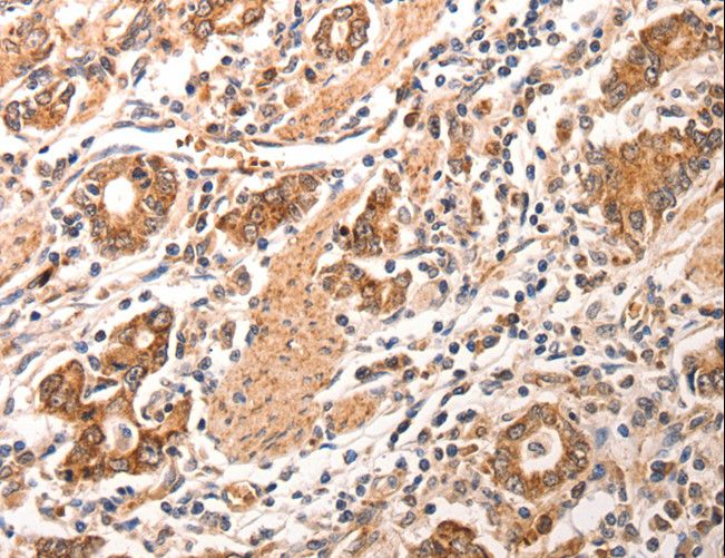 CCL17 / TARC Antibody - Immunohistochemistry of paraffin-embedded Human gastric cancer using CCL17 Polyclonal Antibody at dilution of 1:70.