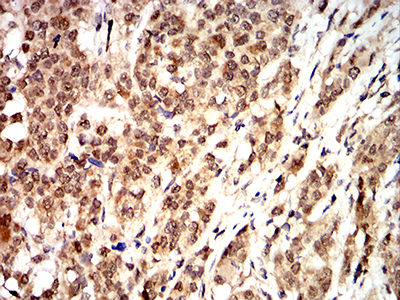 CCND1 / Cyclin D1 Antibody - Immunohistochemical analysis of paraffin-embedded bladder cancer tissues using CCND1 mouse mAb with DAB staining.