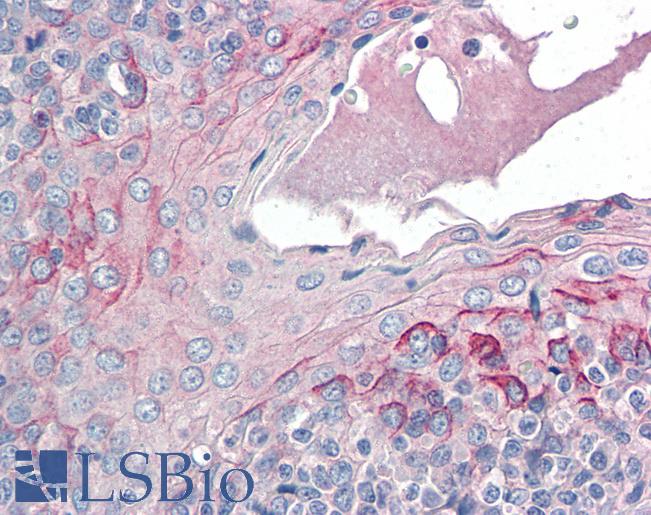 CCR6 Antibody - Anti-CCR6 antibody IHC of human tonsil. Immunohistochemistry of formalin-fixed, paraffin-embedded tissue after heat-induced antigen retrieval. Antibody concentration 5 ug/ml.