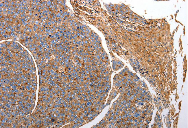 CD151 Antibody - Immunohistochemistry of paraffin-embedded Human liver cancer using CD151 Polyclonal Antibody at dilution of 1:25.