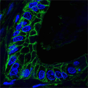 CD44 Antibody - Confocal analysis of paraffin-embedded human lung cancer tissues using CD44 mouse monoclonal antibody (green), showing membrane localization. Blue: DRAQ5 fluorescent DNA dye.