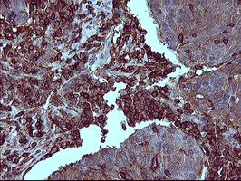 CD45 / LCA Antibody - IHC of paraffin-embedded Carcinoma of Human lung tissue using anti-PTPRC mouse monoclonal antibody.