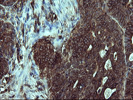 CD45 / LCA Antibody - IHC of paraffin-embedded Carcinoma of Human pancreas tissue using anti-PTPRC mouse monoclonal antibody.