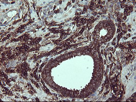 CD45 / LCA Antibody - IHC of paraffin-embedded Carcinoma of Human prostate tissue using anti-PTPRC mouse monoclonal antibody.