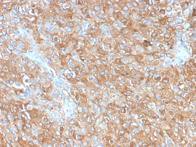 CD63 Antibody - Formalin-fixed, paraffin-embedded human Prostate Carcinoma stained with CD63 Rabbit Recombinant Monoclonal Antibody (LAMP3/2990R).