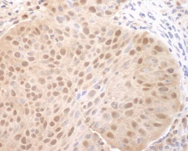 CDC6 Antibody - Detection of Human CDC6 by Immunohistochemistry. Sample: FFPE section of human lung carcinoma. Antibody: Affinity purified rabbit anti-CDC6 used at a dilution of 1:1000 (1 ug/ml).
