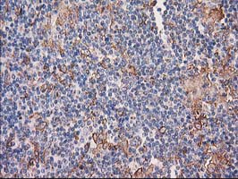 CDCP1 Antibody - IHC of paraffin-embedded Human lymphoma tissue using anti-CDCP1 mouse monoclonal antibody. (Heat-induced epitope retrieval by 10mM citric buffer, pH6.0, 100C for 10min).
