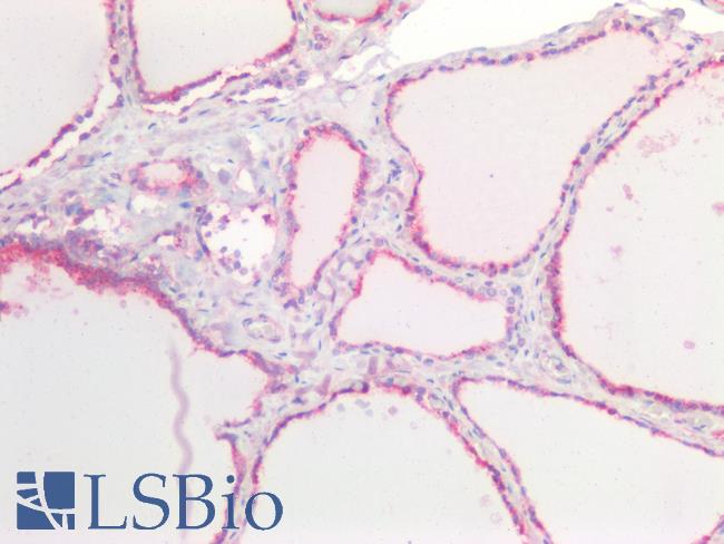 CDH1 / E Cadherin Antibody - Human Thyroid: Formalin-Fixed, Paraffin-Embedded (FFPE)