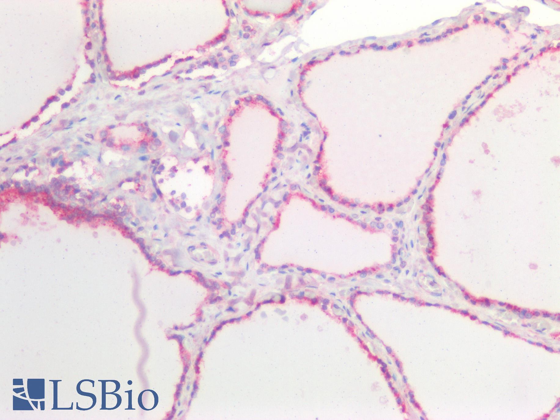 CDH1 / E Cadherin Antibody - Human Thyroid: Formalin-Fixed, Paraffin-Embedded (FFPE)