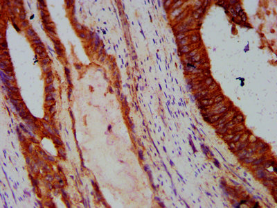 CDH1 / E Cadherin Antibody - Immunohistochemistry Dilution at 1:300 and staining in paraffin-embedded human colon cancer performed on a Leica BondTM system. After dewaxing and hydration, antigen retrieval was mediated by high pressure in a citrate buffer (pH 6.0). Section was blocked with 10% normal Goat serum 30min at RT. Then primary antibody (1% BSA) was incubated at 4°C overnight. The primary is detected by a biotinylated Secondary antibody and visualized using an HRP conjugated SP system.