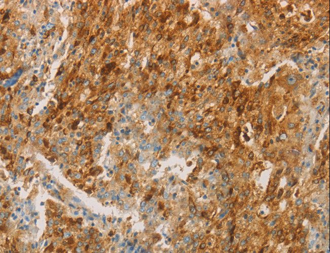 CEACAM8 / CD66b Antibody - Immunohistochemistry of paraffin-embedded Human gastric cancer using CEACAM8 Polyclonal Antibody at dilution of 1:30.