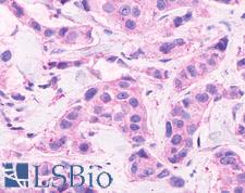 CELSR2 Antibody - Anti-CELSR2 antibody IHC of human Breast, Carcinoma. Immunohistochemistry of formalin-fixed, paraffin-embedded tissue after heat-induced antigen retrieval.