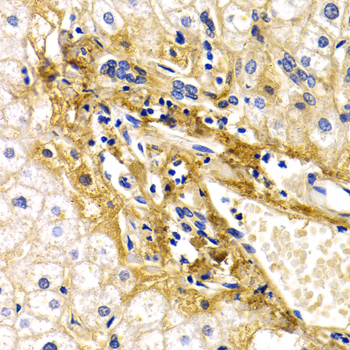 CFH / Complement Factor H Antibody - Immunohistochemistry of paraffin-embedded human liver damage.