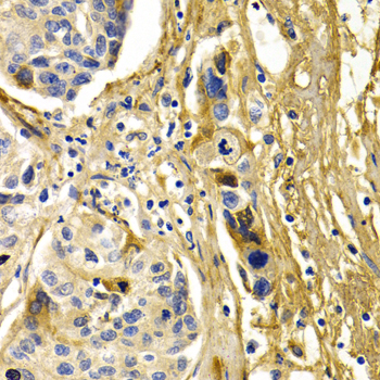 CFH / Complement Factor H Antibody - Immunohistochemistry of paraffin-embedded human liver cancer tissue.