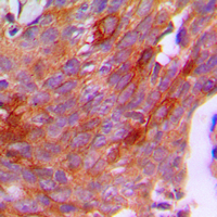 CGB / hCG Beta Antibody - Immunohistochemical analysis of CG beta staining in human breast cancer formalin fixed paraffin embedded tissue section. The section was pre-treated using heat mediated antigen retrieval with sodium citrate buffer (pH 6.0). The section was then incubated with the antibody at room temperature and detected using an HRP conjugated compact polymer system. DAB was used as the chromogen. The section was then counterstained with hematoxylin and mounted with DPX.