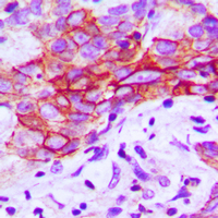 CHEMR23 / CMKLR1 Antibody - Immunohistochemical analysis of CMKLR1 staining in human breast cancer formalin fixed paraffin embedded tissue section. The section was pre-treated using heat mediated antigen retrieval with sodium citrate buffer (pH 6.0). The section was then incubated with the antibody at room temperature and detected using an HRP conjugated compact polymer system. DAB was used as the chromogen. The section was then counterstained with hematoxylin and mounted with DPX.