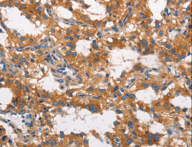 CLTC / Clathrin Heavy Chain Antibody - Immunohistochemistry of paraffin-embedded Human thyroid cancer using CLTC Polyclonal Antibody at dilution of 1:60.