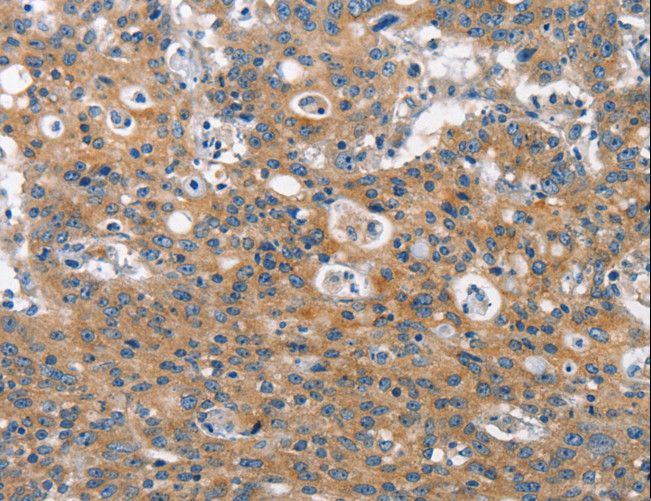 CLTC / Clathrin Heavy Chain Antibody - Immunohistochemistry of paraffin-embedded Human gastric cancer using CLTC Polyclonal Antibody at dilution of 1:60.