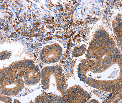 CNTFR Antibody - Immunohistochemistry of paraffin-embedded human colon cancer tissue using CNTFR antibody.