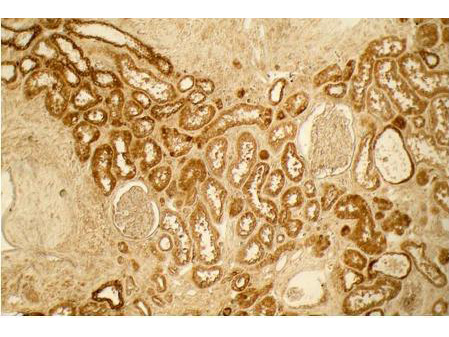 Collagen VI Antibody - Immunohistochemistry of Collagen I antibody. Tissue: Normal Kidney. Fixation: formalin fixed paraffin embedded. Antigen retrieval: No antigen retrieval was performed. Primary antibody: Collagen I 1:100 4 hours at room temperature Secondary antibody: Peroxidase goat anti-rabbit at 1:10000 for 45 min at RT. Localization: Distal tubules in normal kidney tissue. Note the absence of staining of glomeruli. Staining: antibody as precipitated red signal with a hematoxylin purple nuclear counterstain.