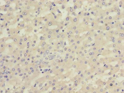 Complement C5 Antibody - Immunohistochemistry of paraffin-embedded human liver cancer using antibody at dilution of 1:100.