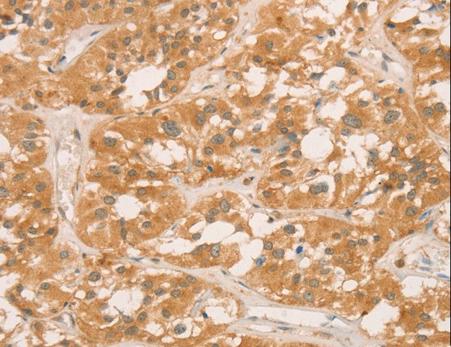 CPB / Carboxypeptidase B Antibody - Immunohistochemistry of paraffin-embedded Human gastric cancer using CPB1 Polyclonal Antibody at dilution of 1:60.