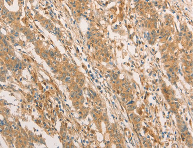 CPB / Carboxypeptidase B Antibody - Immunohistochemistry of paraffin-embedded Human gastric cancer using CPB1 Polyclonal Antibody at dilution of 1:60.