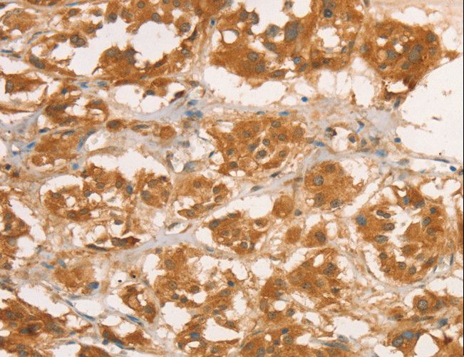 CPB / Carboxypeptidase B Antibody - Immunohistochemistry of paraffin-embedded Human breast cancer using CPB1 Polyclonal Antibody at dilution of 1:50.