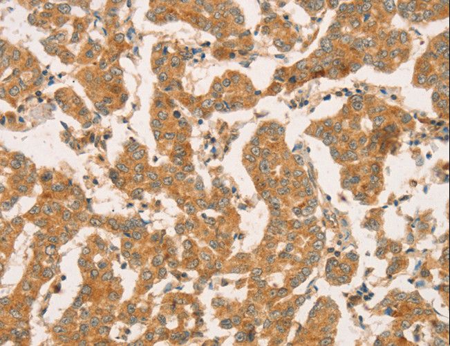CPB / Carboxypeptidase B Antibody - Immunohistochemistry of paraffin-embedded Human breast cancer using CPB1 Polyclonal Antibody at dilution of 1:50.