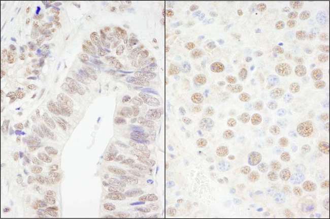 CPSF6 Antibody - Detection of Human and Mouse CPSF68 by Immunohistochemistry. Sample: FFPE section of human colon carcinoma (left) and mouse renal cell carcinoma (right). Antibody: Affinity purified rabbit anti-CPSF68 used at a dilution of 1:200 (1 ug/ml). Detection: DAB.