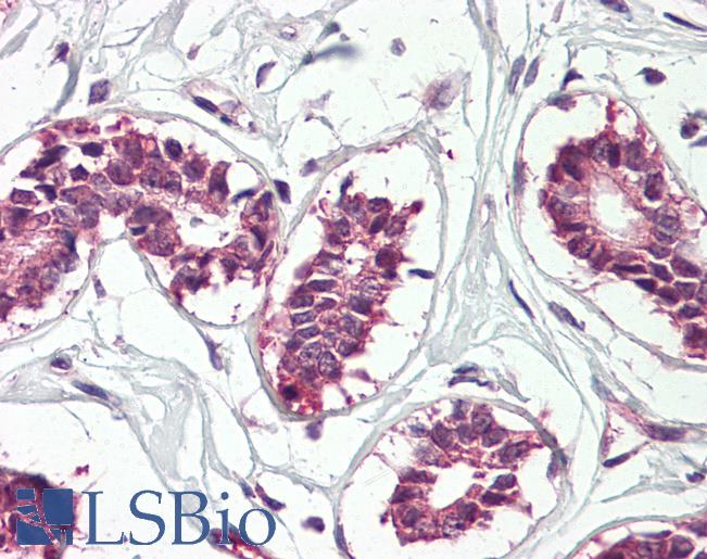 CRD-BP / ZBP1 / IGF2BP1 Antibody - Anti-CRD-BP / IGF2BP1 antibody IHC of human breast. Immunohistochemistry of formalin-fixed, paraffin-embedded tissue after heat-induced antigen retrieval. Antibody dilution 3.75 ug/ml.