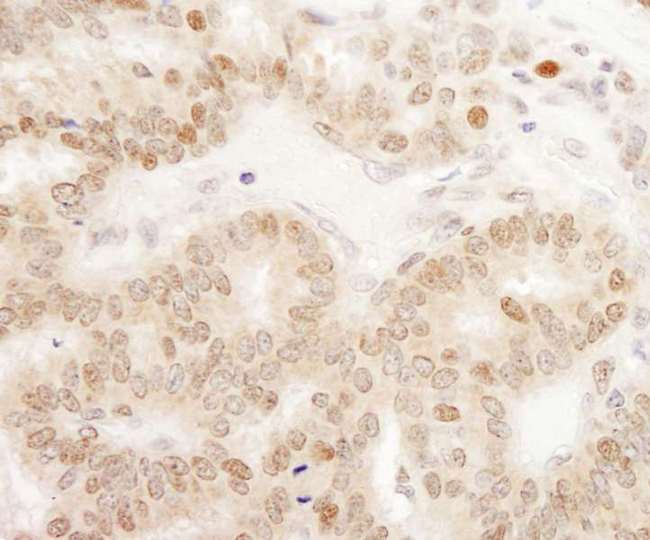 CRTC1 / MECT1 / TORC1 Antibody - Detection of Human TORC1 by Immunohistochemistry. Sample: FFPE section of human breast carcinoma. Antibody: Affinity purified rabbit anti-TORC1 used at a dilution of 1:200 (1 ug/ml). Detection: DAB.