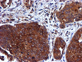 CST3 / Cystatin C Antibody - IHC of paraffin-embedded Carcinoma of Human lung tissue using anti-CST3 mouse monoclonal antibody.