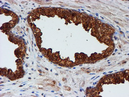 CST3 / Cystatin C Antibody - IHC of paraffin-embedded Carcinoma of Human prostate tissue using anti-CST3 mouse monoclonal antibody.