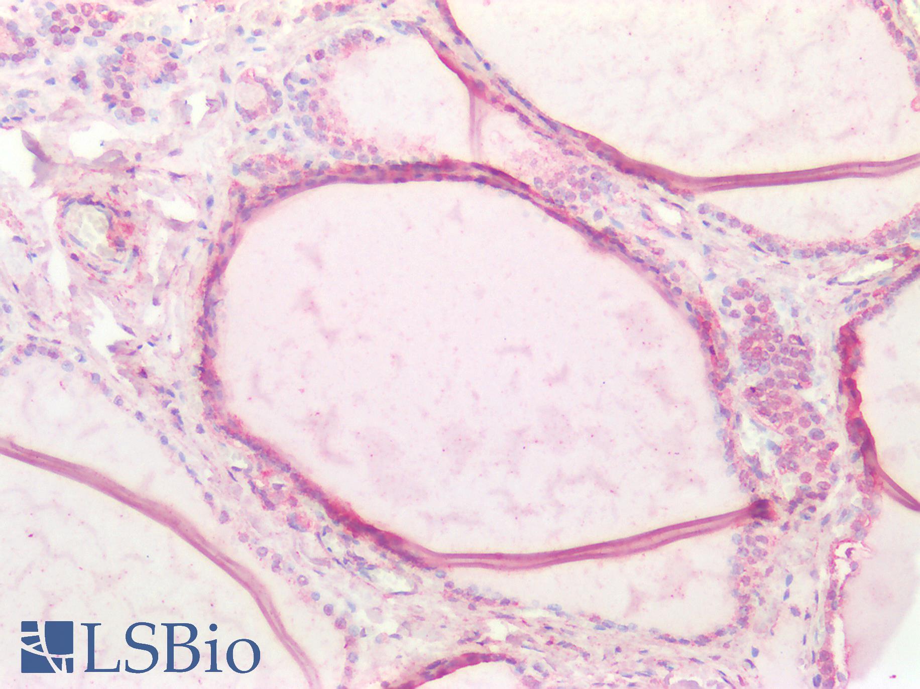 CTSB / Cathepsin B Antibody - Human Thyroid: Formalin-Fixed, Paraffin-Embedded (FFPE)