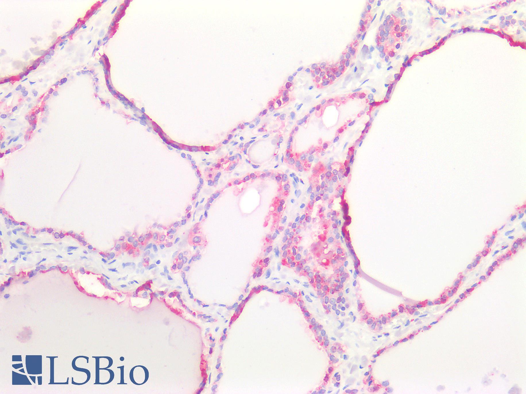 CTSB / Cathepsin B Antibody - Human Thyroid: Formalin-Fixed, Paraffin-Embedded (FFPE)