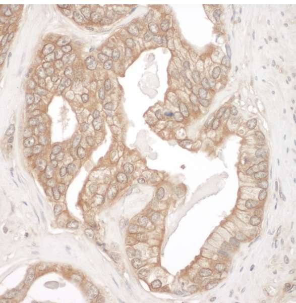 CTTN / Cortactin Antibody - Detection of Human Cortactin by Immunohistochemistry. Sample: FFPE section of human prostate carcinoma. Antibody: Affinity purified rabbit anti-Cortactin used at a dilution of 1:1000 (0.2 ug/ml). Detection: DAB.