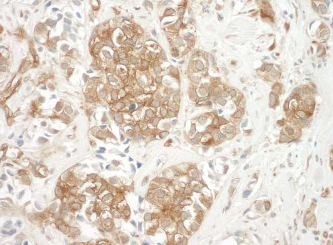CTTN / Cortactin Antibody - Detection of Human Cortactin by Immunohistochemistry. Sample: FFPE section of human breast carcinoma. Antibody: Affinity purified rabbit anti-Cortactin used at a dilution of 1:250.