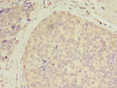CXCL6 Antibody - Immunohistochemistry of paraffin-embedded human gastric cancer using antibody at dilution of 1:100.