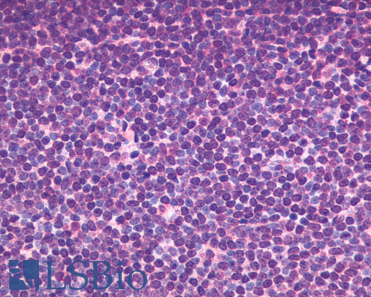 CXCR5 Antibody - Anti-CXCR5 antibody IHC of human Lymph Node, B-Cell, Mantle Cell Lymphoma. Immunohistochemistry of formalin-fixed, paraffin-embedded tissue after heat-induced antigen retrieval.